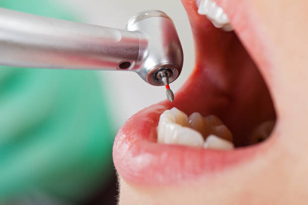 Best Emergency Dental Care for Broken or Chipped Teeth in , AL